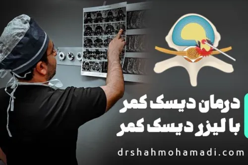 چگونگی درمان دیسک کمر با لیزر دیسک کمر PLDD و سفارش های جراح متخصص