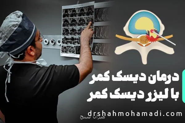 چگونگی درمان دیسک کمر با لیزر دیسک کمر PLDD و سفارش های جراح متخصص